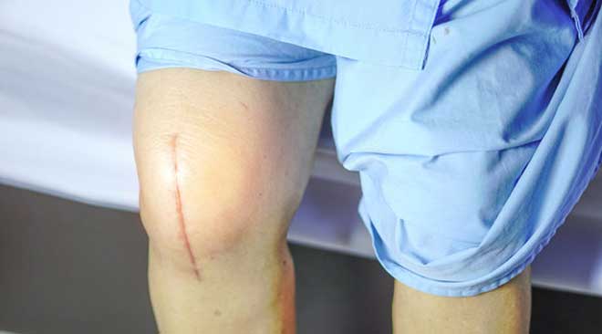 Замена, или эндопротезирование коленного сустава, это серьезная операция, и после нее требуется целая программа реабилитации для восстановления подвижности и функциональности.